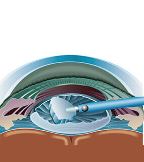 Cataract Surgery Treatment in Hyderabad