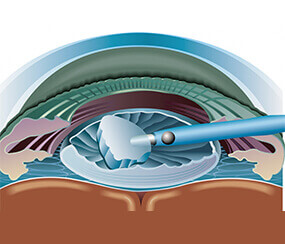 Cataract Surgery Treatment in Hyderabad